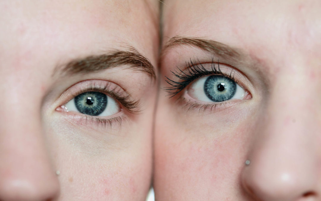 Augenringe effizient unterspritzen und entfernen