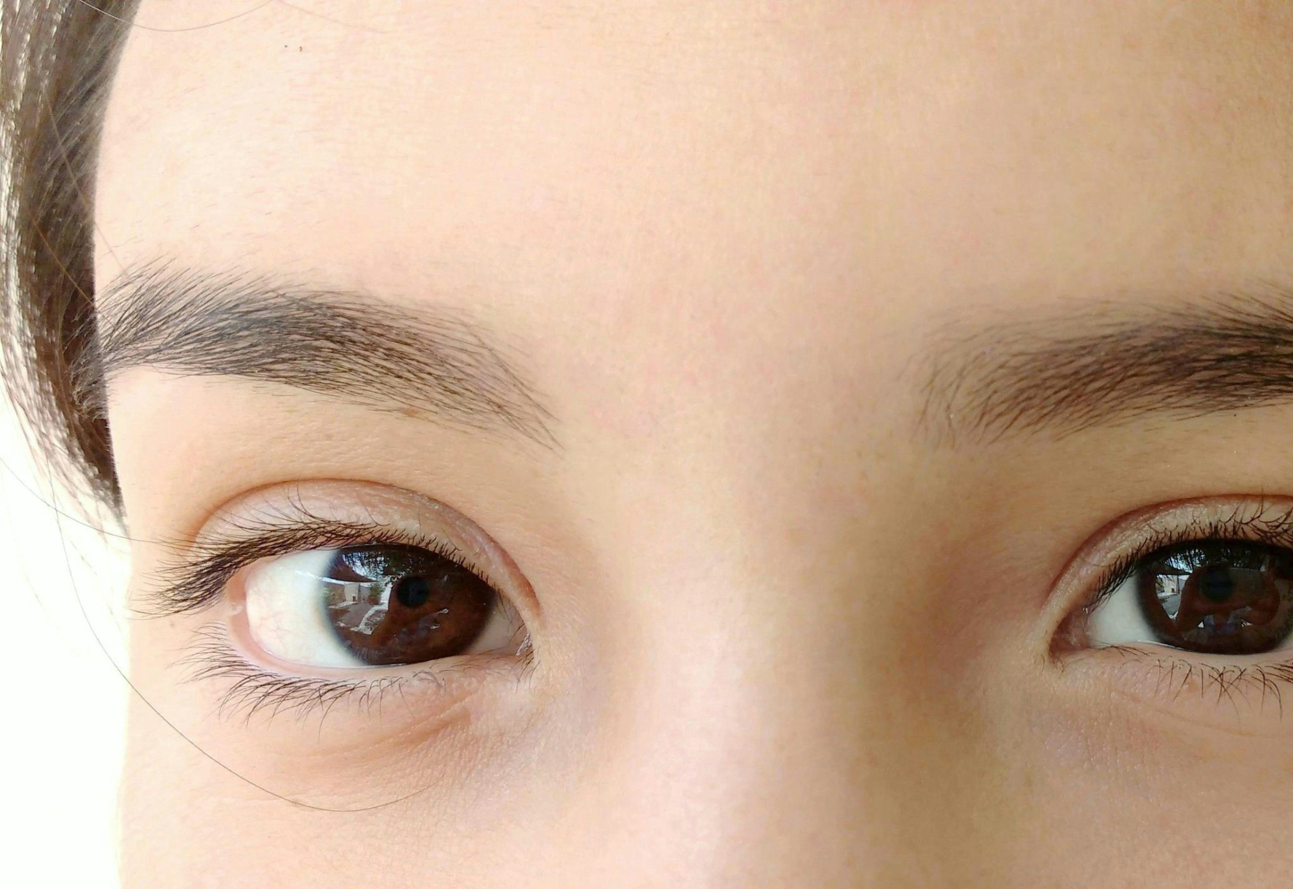 Augenringe unterspritzen VorherNachher Transformation Dr. Linde Blog