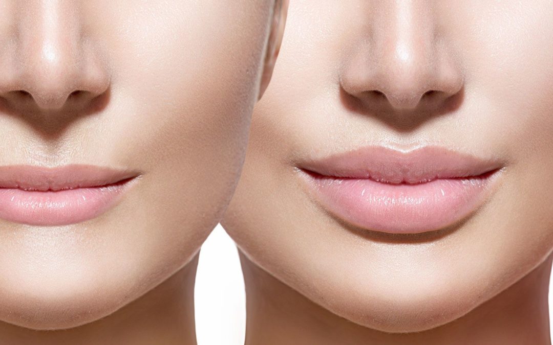 Permanent Lip Filler