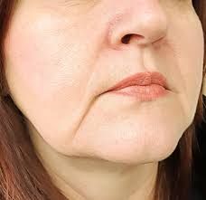 Understanding Marionette Lines: Causes and Treatments