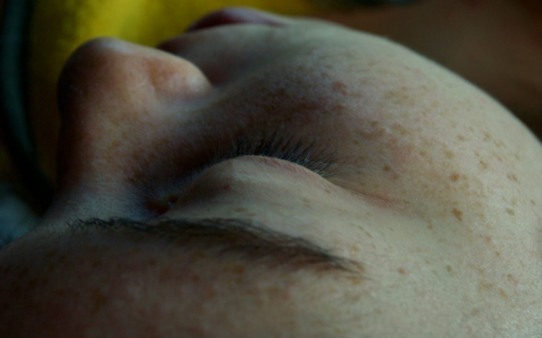 Comprehensive Guide to Using Laser for Sun Spots on Face