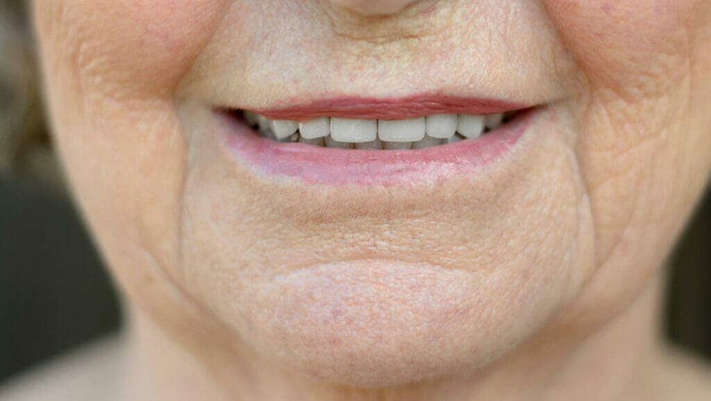 Understanding Filler in Mouth Lines: Causes and Treatments