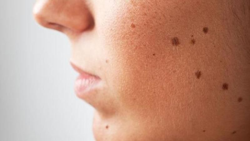 Lasering Moles Off Face: Comprehensive Guide and Insights