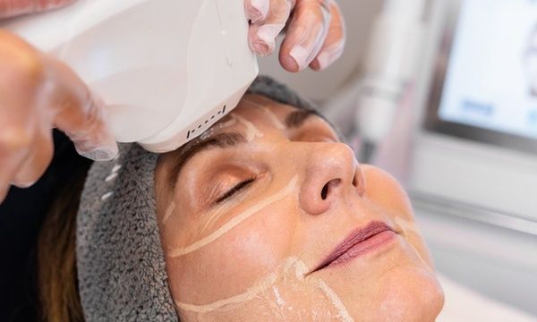 Hypho Face Lift: Your Guide to Ultrasound Facelifts