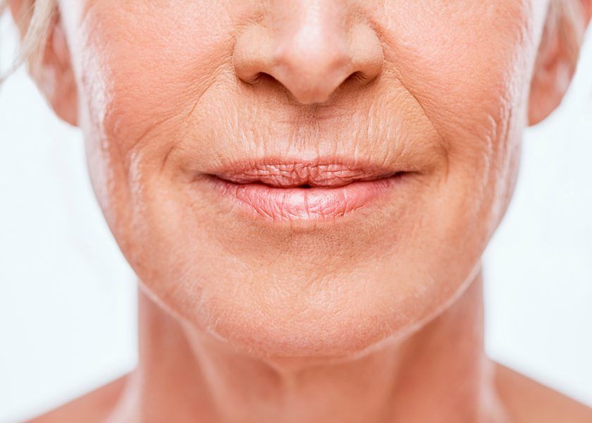 Comprehensive Guide to Laser for Smokers Lines Treatment