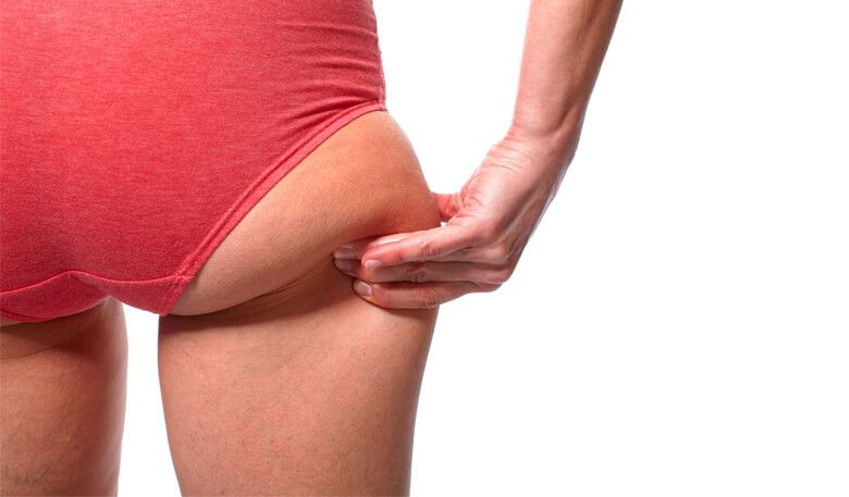 Comprehensive Guide to Remove Fat from Buttocks Surgery