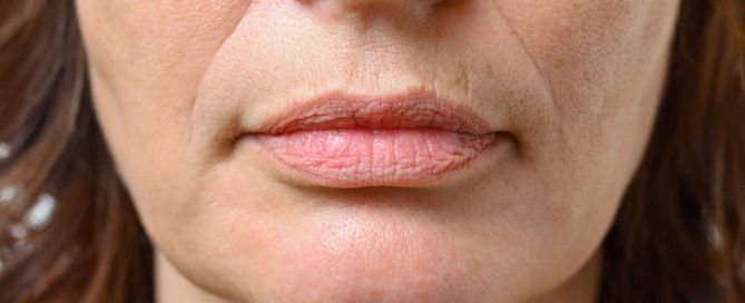 Microneedling for Marionette Lines: A Comprehensive Guide