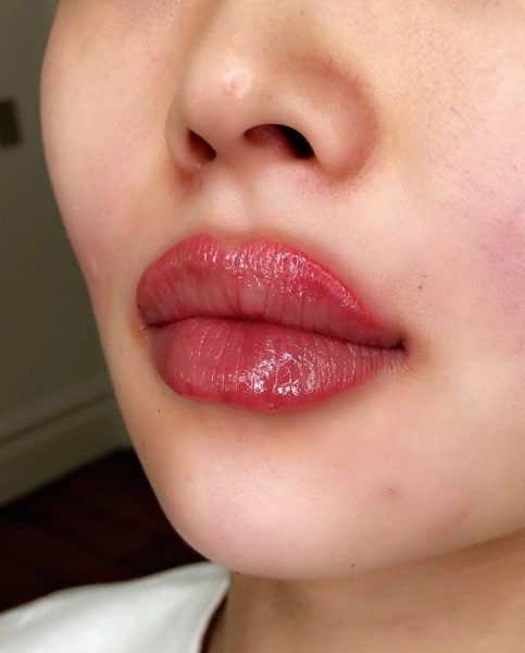 Russian Lip Fillers: Your Ultimate Guide