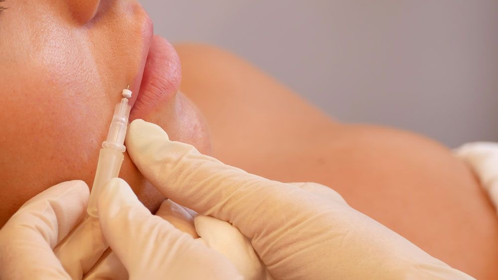 Unlock the Potential of PDO Lip Threads for Enhanced Beauty