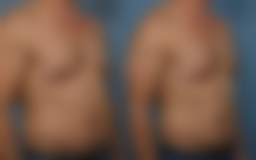 Understanding Men Breast Lift: A Comprehensive Guide