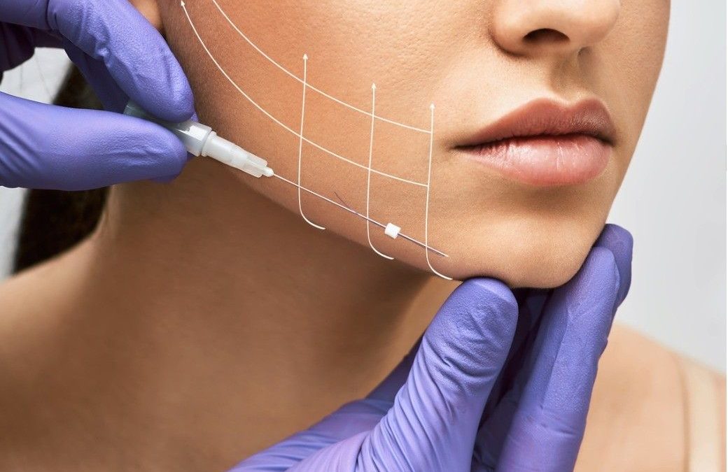 Understanding Collagen Threads Cost and Thread Lift Pricing
