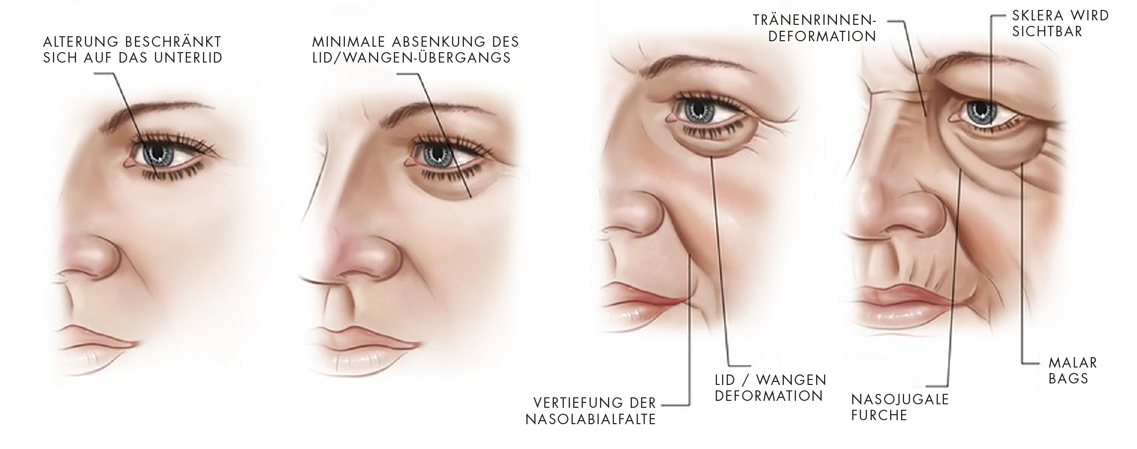 Ursachen Augenringe