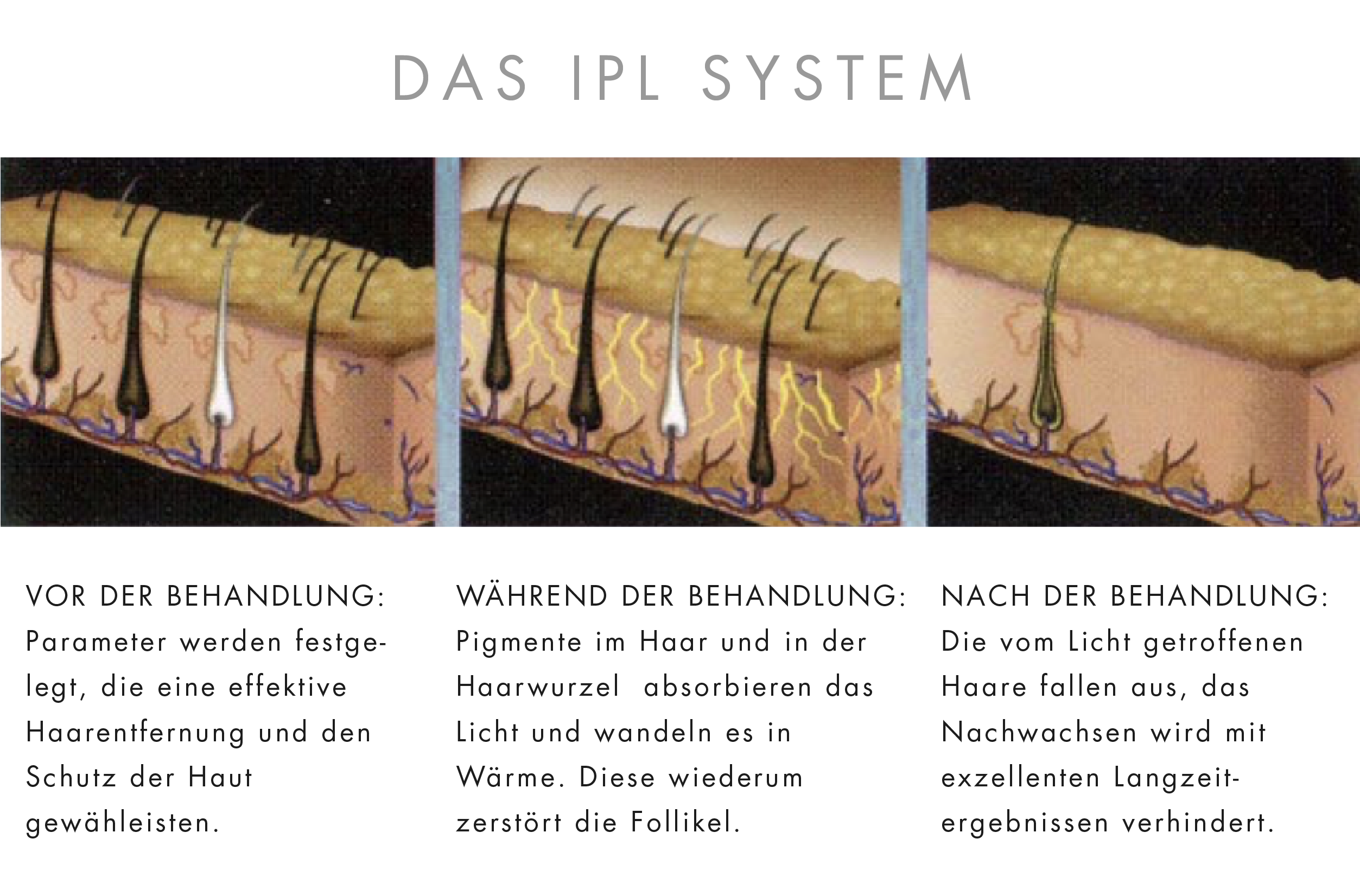 IPL Dauerhafte Haarentfernung