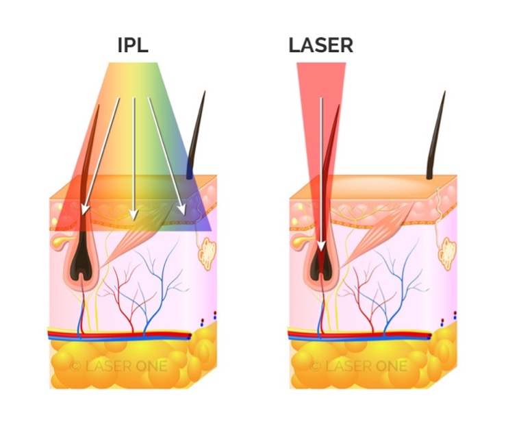 IPL oder Laser zur Haarentfernung