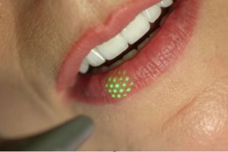 Lippenvergrösserung mit Laser