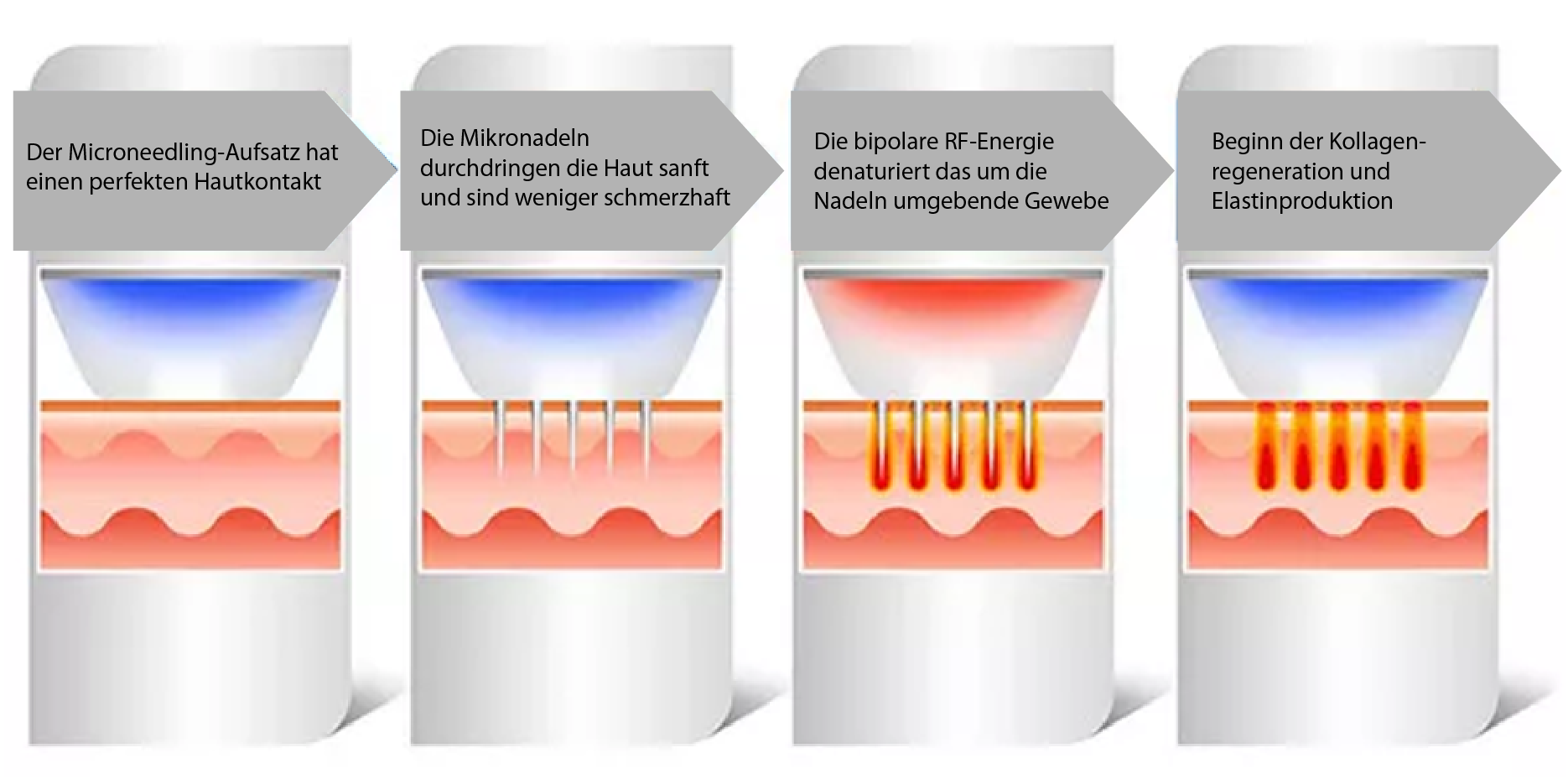 RF Microneedling