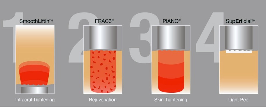 Smoothlift Facelifting Laser