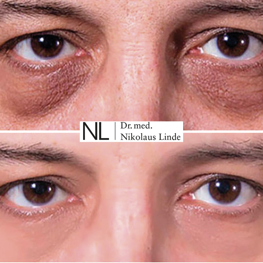 Augenringe Augenringe BEAUTYCLINIC