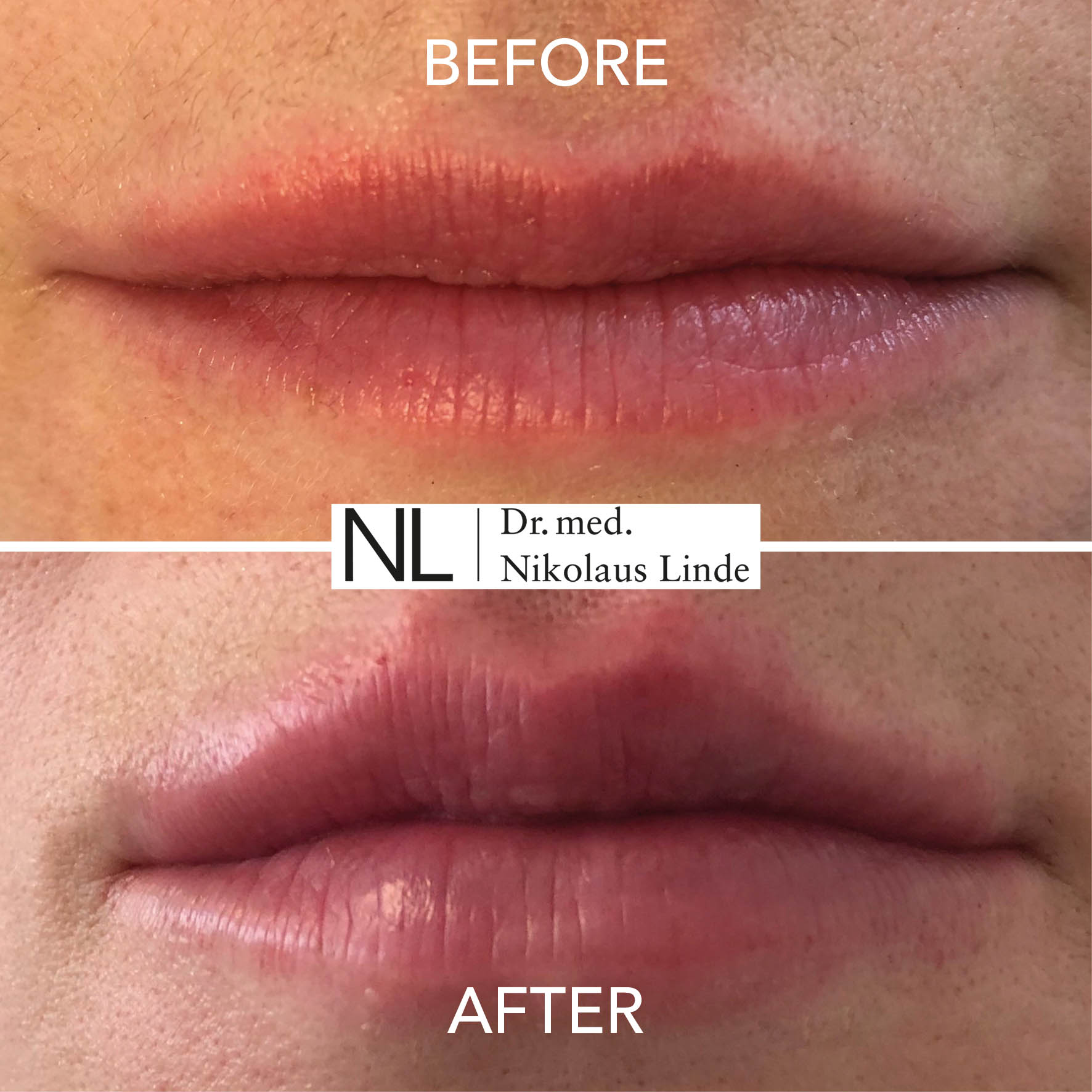 Lippen vorher / nachher Bilder