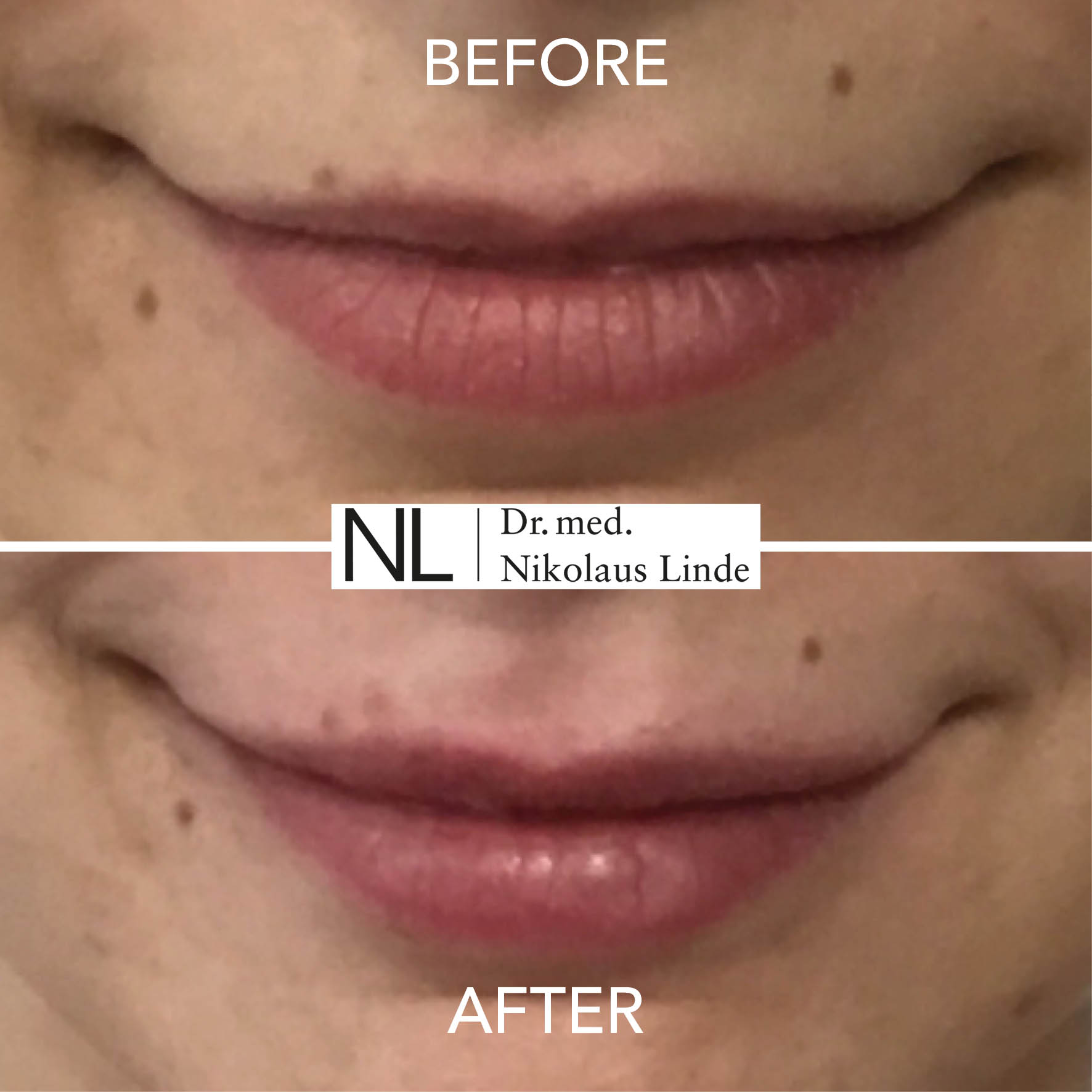 Lippen vorher / nachher Bilder