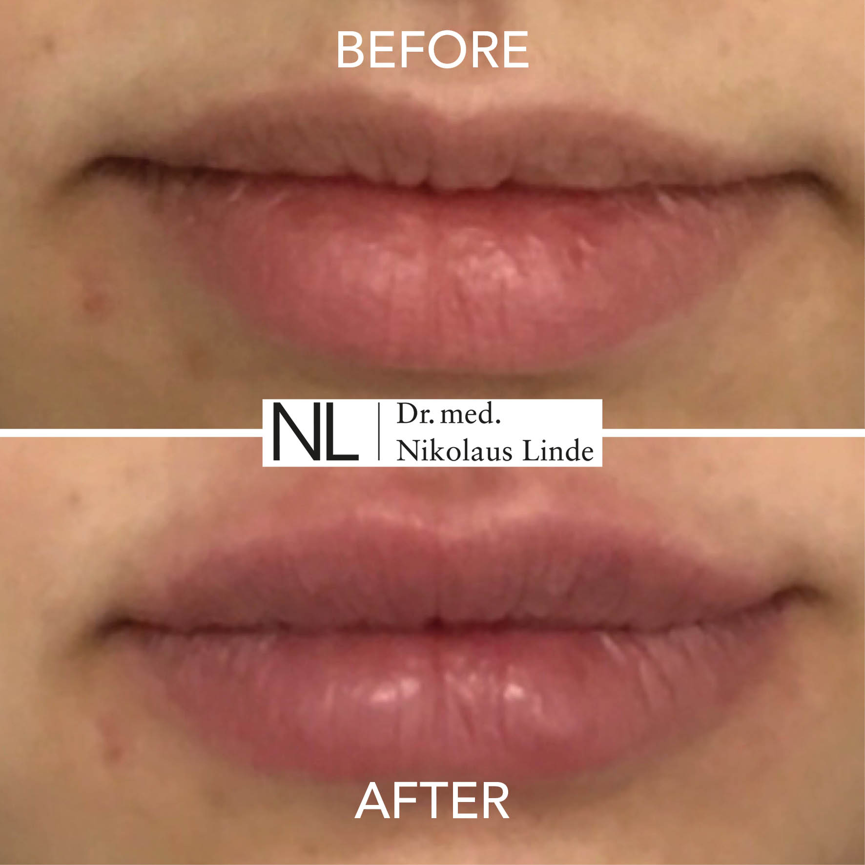 Lippen vorher / nachher Bilder