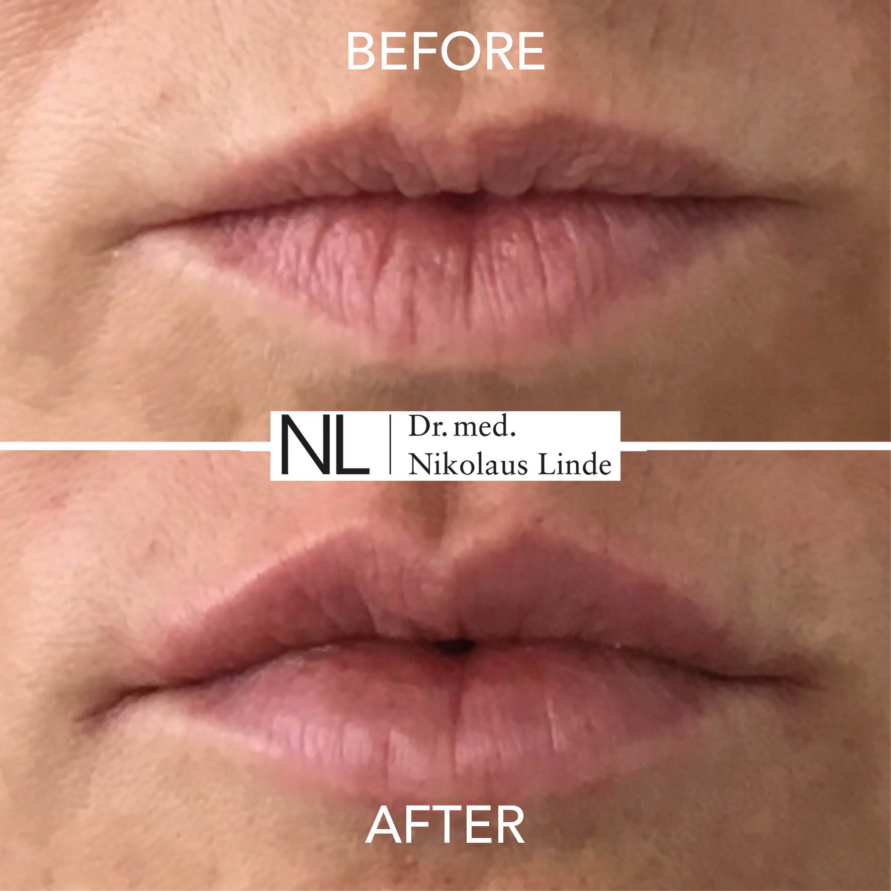 0 55 Ml Hyaluronsäure Lippen Vorher Nachher Lippen | vorher / nachher Bilder