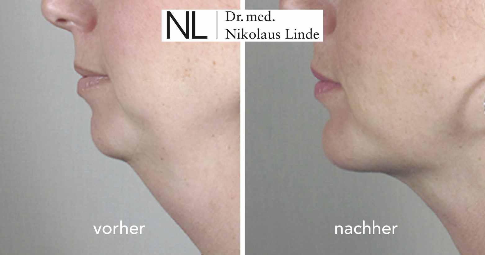 Doppelkinn entfernen VorherNachherBilder BEAUTYCLINIC