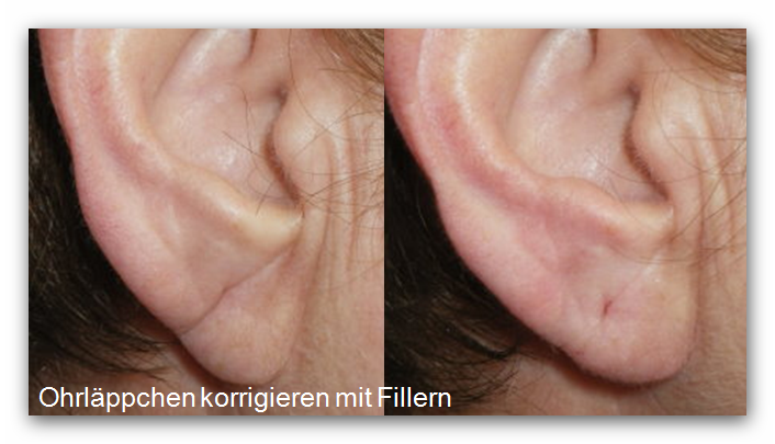Falte Im Ohrläppchen Durch Ohrring www.beautyclinic.ch