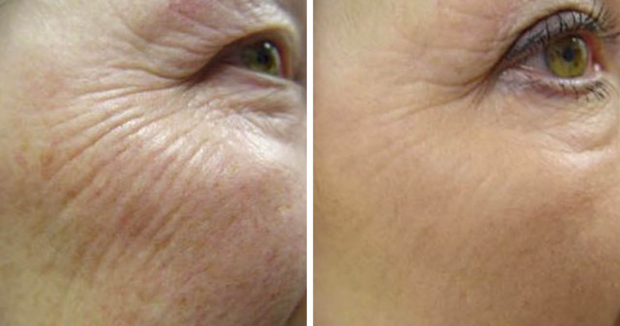 SmoothEye® Eyelid Laserlifting SmoothEye® BEAUTYCLINIC