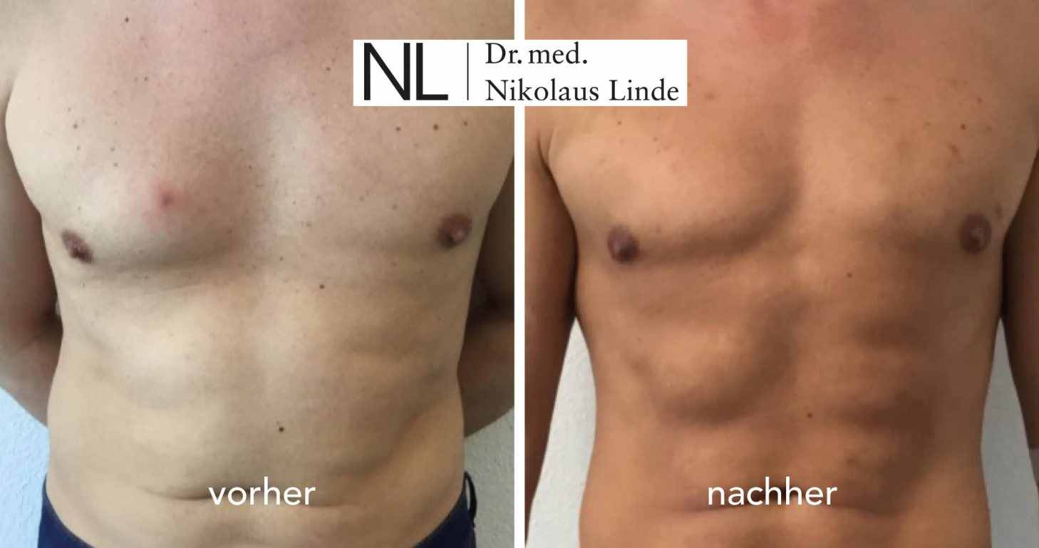 Sixpack OP Mann VorherNachherBilder