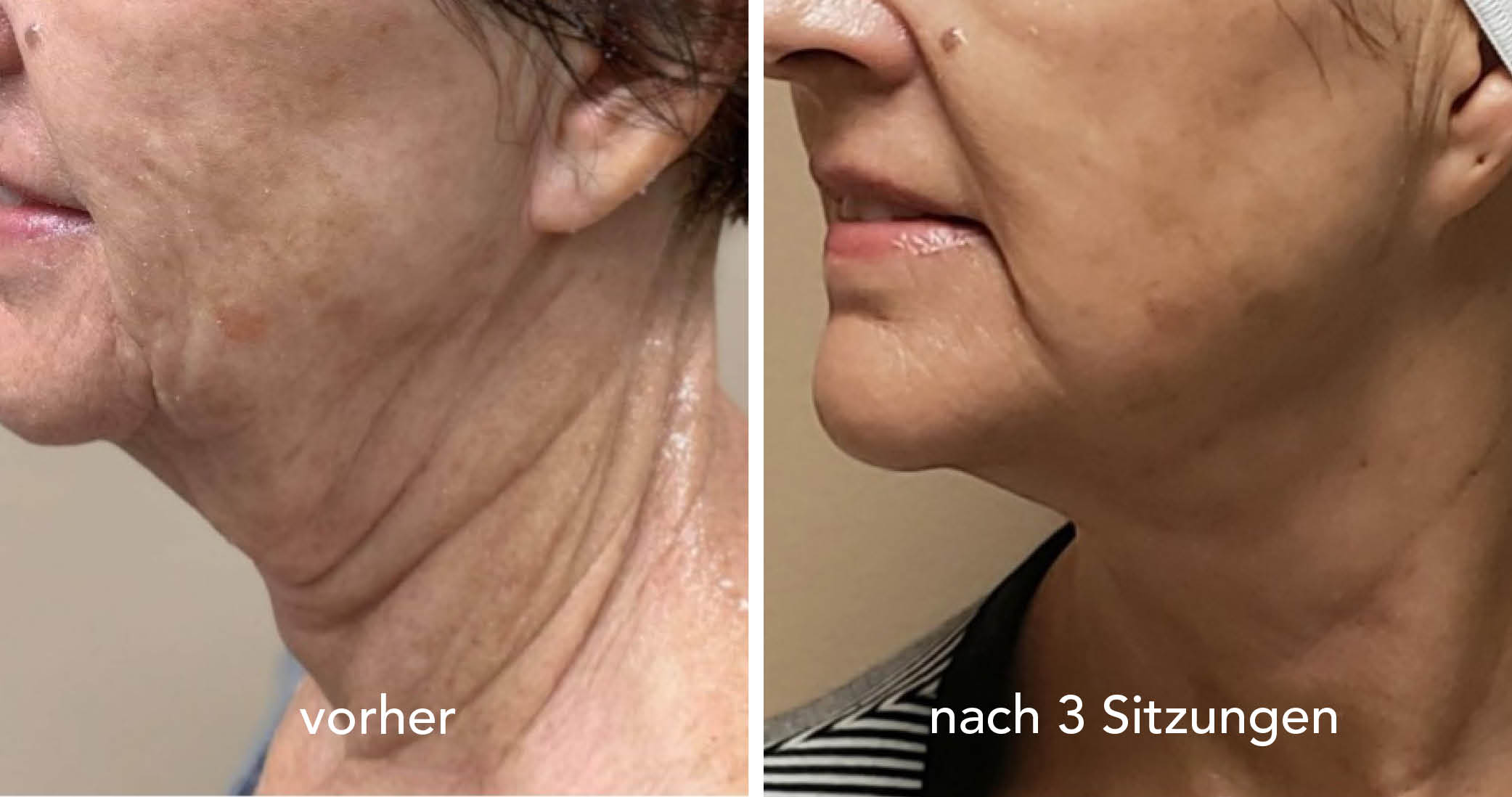 Morpheus 8 Morpheus 8 BEAUTYCLINIC