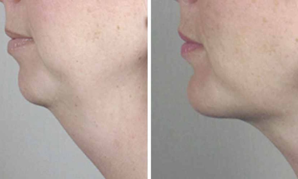 Doppelkinn entfernen VorherNachherBilder BEAUTYCLINIC