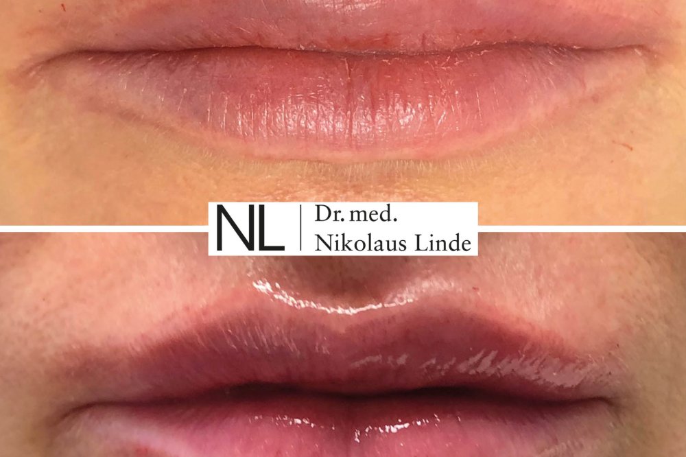 0 55 Ml Hyaluronsäure Lippen Vorher Nachher Lippen | vorher / nachher Bilder