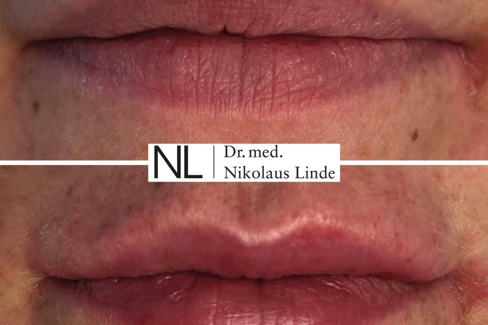 Faszinierend Geschwollene Lippen Erkaltung Ebenbild