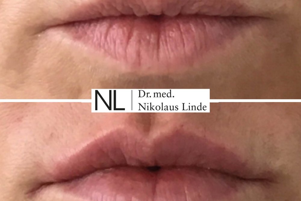 Lippen vorher / nachher Bilder
