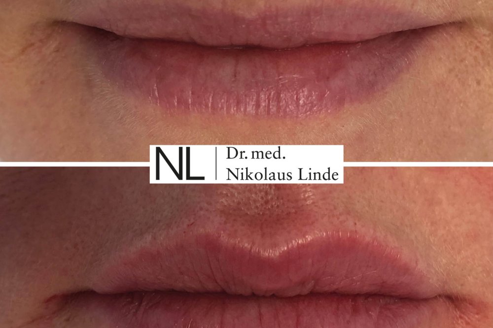 Lippen vorher / nachher Bilder