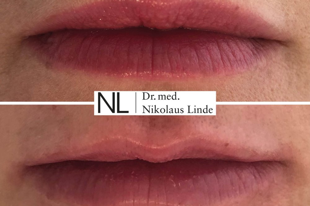 Lippen vorher / nachher Bilder