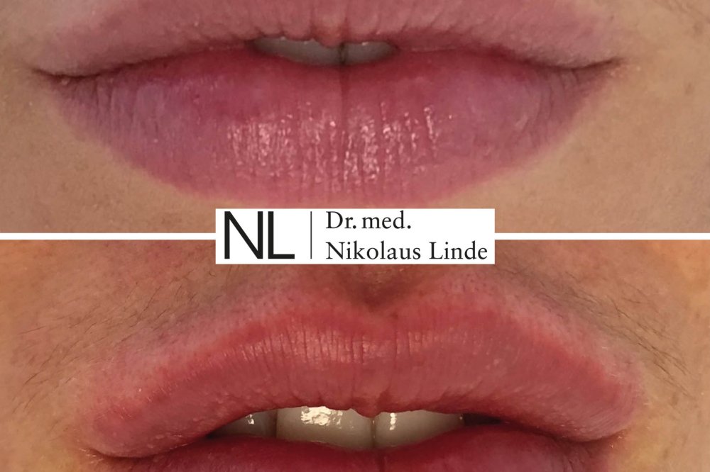 Lippen vorher / nachher Bilder