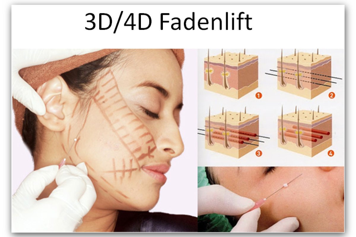 3D Mesofaden Lift