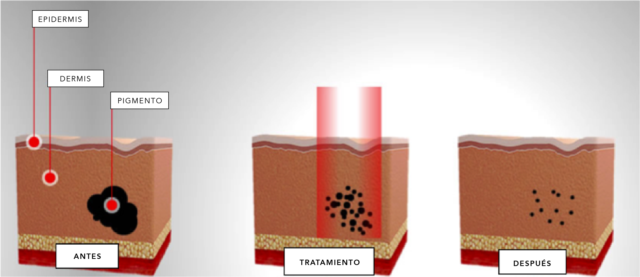 Eliminacion de tatuajes