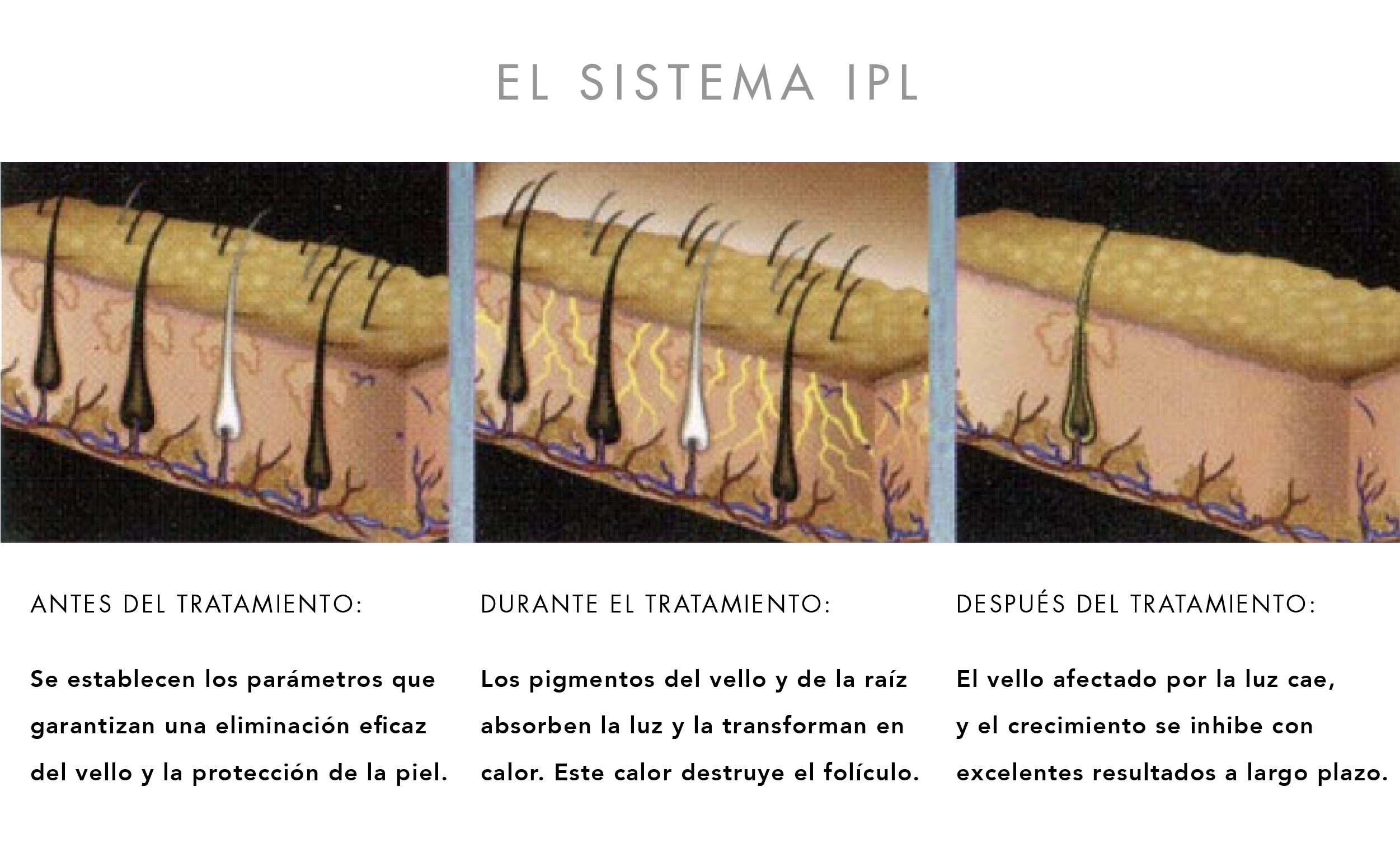 IPL DEPILACIÓN PERMANENTE