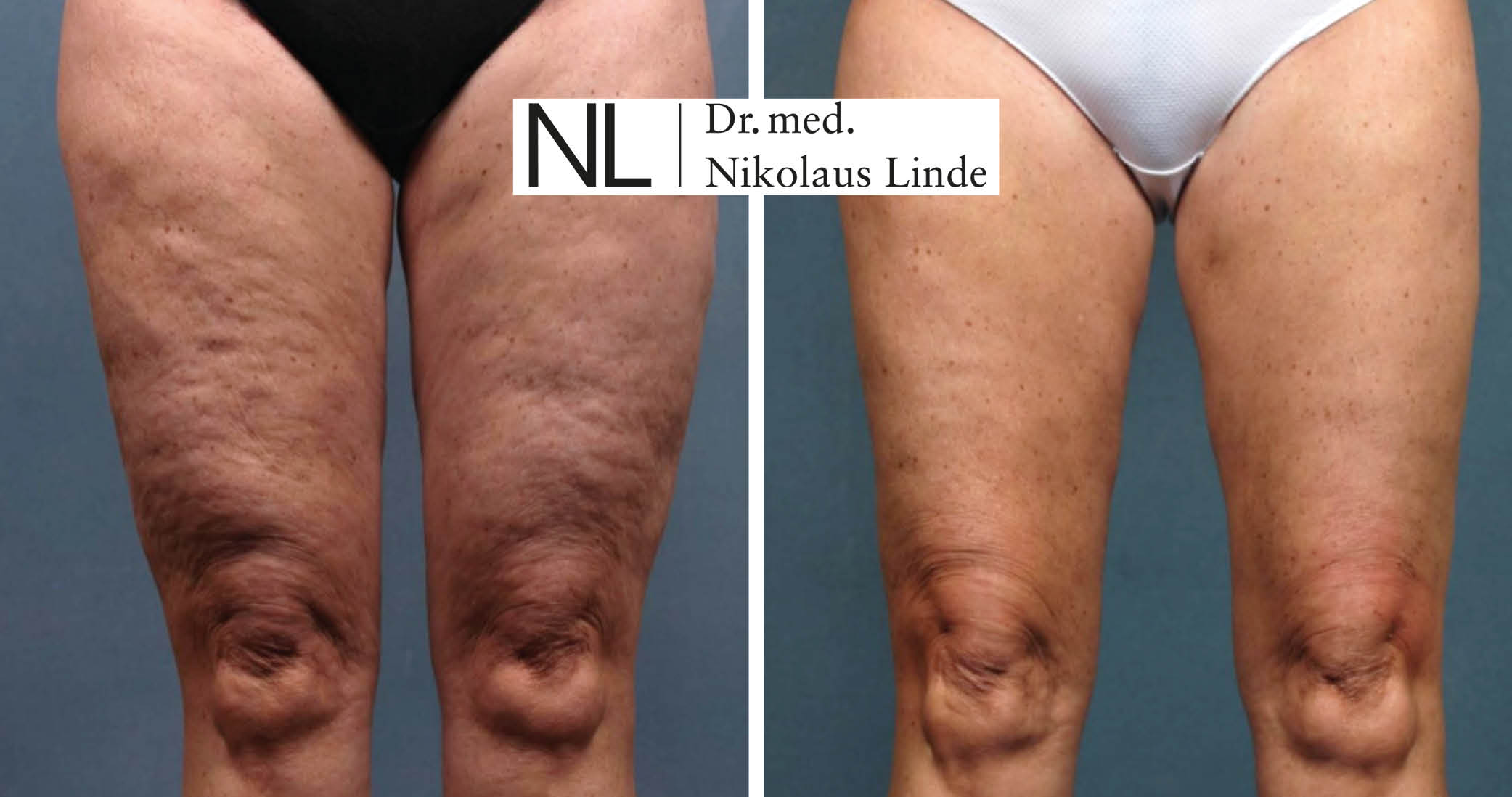 Galerie Cellulite Behandlung Cellu supercharged