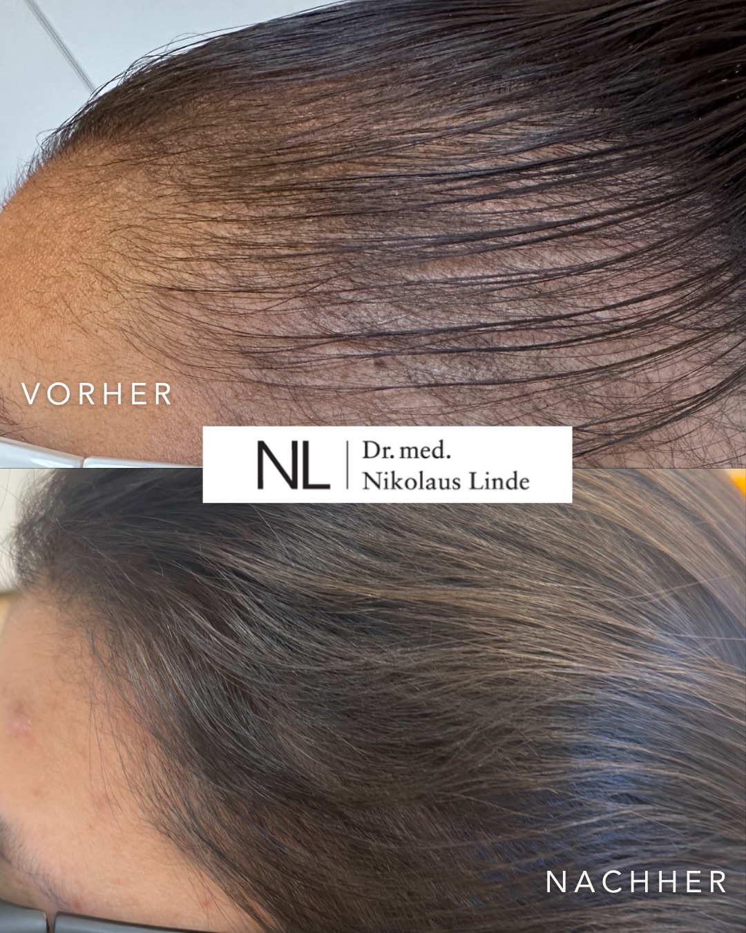 Haarwachstum Vorher-Nachher-Ergebnis