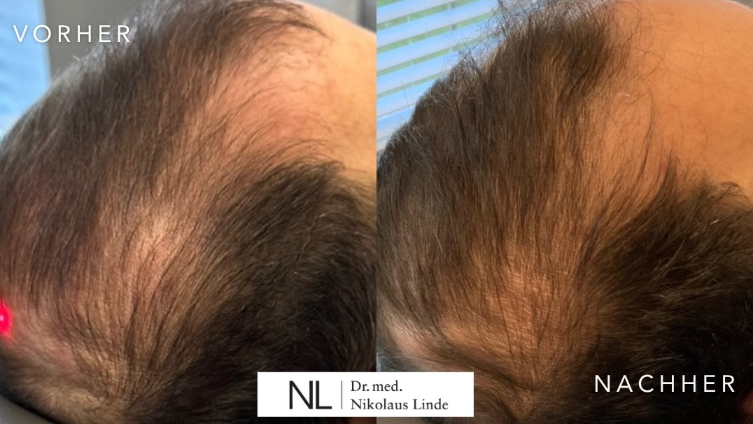 Behandlung gegen Haarverlust Vorher-Nachher-Ergebnis