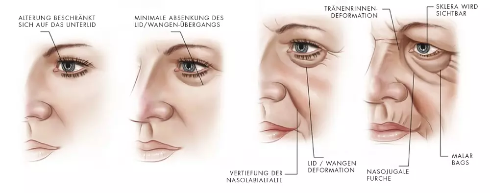 Ursachen Augenringe