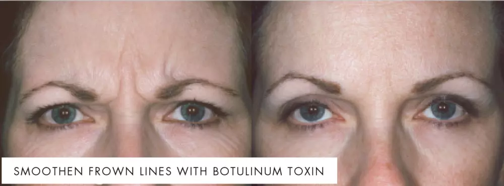 Wrinkle treatment