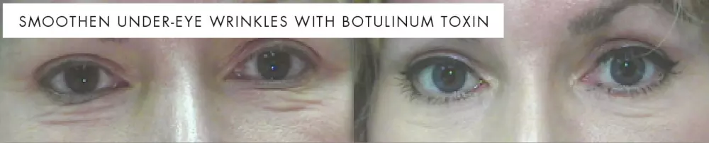 Lower eyelid wrinkles