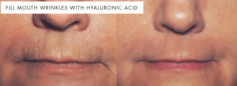 upper lip wrinkles
