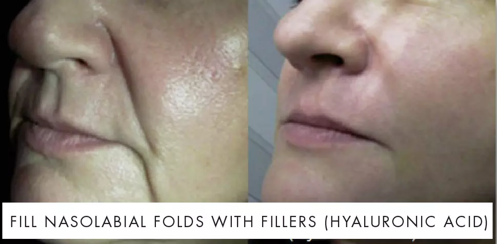 Nasolabial folds treatment