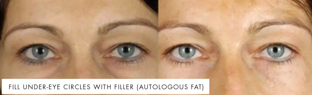 Treating dark circles and bags under the eyes